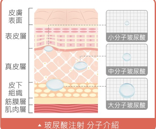 玻尿酸注射分子介紹圖，顯示小分子、中分子與大分子玻尿酸分別對應表皮層、真皮層與皮下組織