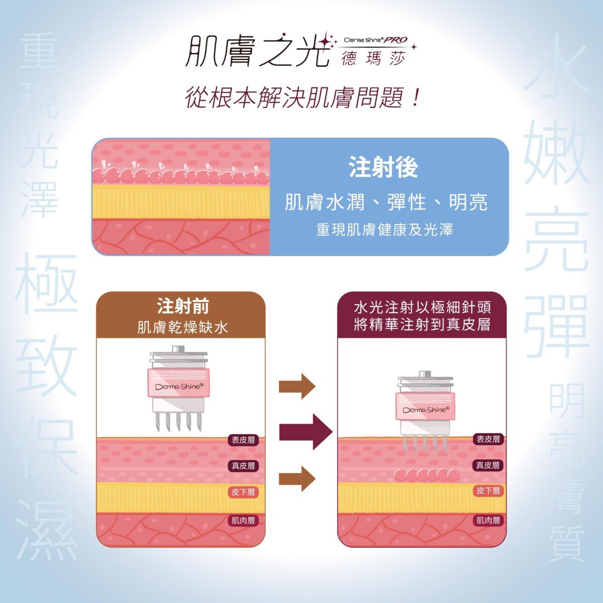 德瑪莎水光注射機轉圖，顯示以極細針頭將精華注射到真皮層，皮膚層次由上而下為表皮層、真皮層、皮下層、肌肉層