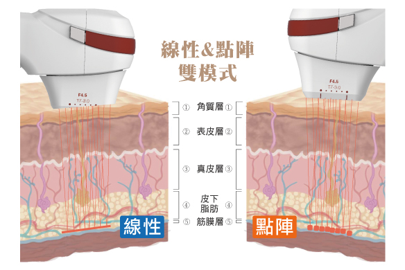 咻音波線性與點陣雙模式在皮膚各層的能量分布比較圖，涵蓋角質層、表皮層、真皮層、皮下脂肪與筋膜層